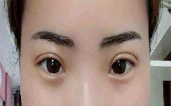 丁硯江填充脂肪的效果如何？為什么該方法備受推崇？