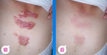 九院脂肪填充，醫(yī)生技術(shù)高超，詳細(xì)價(jià)格表揭曉