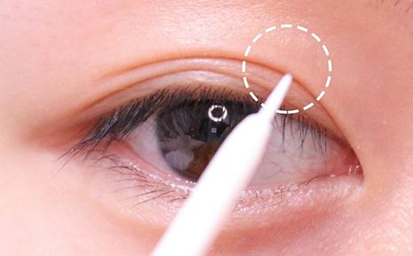 成都成美整形醫(yī)院的脂肪溶解術(shù)成功案例公開(kāi)