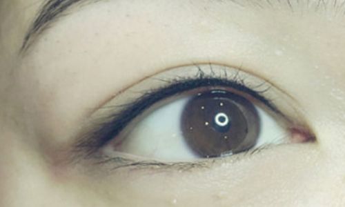 雷少榕做雙眼皮手術(shù)費用！專家介紹手術(shù)技術(shù)和熟練度