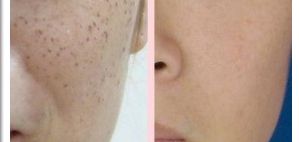 郭金冉面部填充成本公開！醫(yī)生個人技術(shù)評價曝光！在線案例展示！