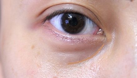 【重慶】銅雀臺(tái)雙眼皮醫(yī)生技術(shù)對比，伍森林、王杰醫(yī)、梁海彬誰更厲害？