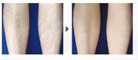 脂肪豐額頭手術(shù)的效果如何？了解專家的分享