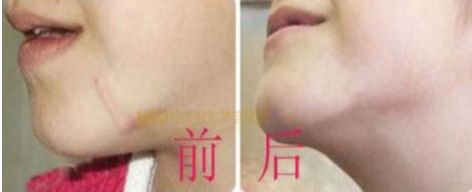 長沙最佳吸脂手術(shù)醫(yī)院排名，雅美、華韓華美、鵬愛等值得借鑒的評價