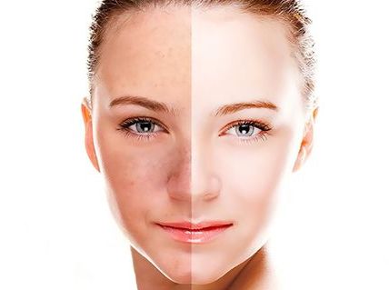 深圳米蘭柏羽整形醫(yī)院王志東醫(yī)生雙眼皮價格及成功案例分享