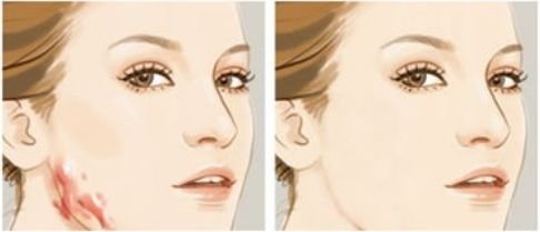 成都光子嫩膚的醫(yī)院選擇有哪些？推薦值得信賴的三甲公立機(jī)構(gòu)！