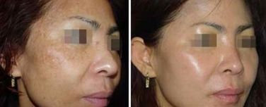 探索誰(shuí)是脂肪填充領(lǐng)域的專家