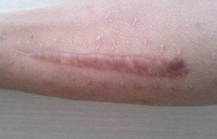 北京藝星白書白師傅，2023獨家案例揭秘：雙眼皮手術(shù)讓你閃耀美麗！