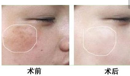 長沙美田芳斌雙眼皮讓你驚艷！令人難忘的改變來襲！