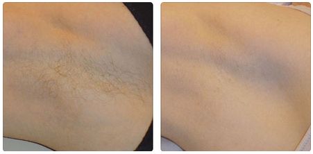 吳氏嘉美的雙眼皮做得好嗎？真實口碑曝光，價格查詢附上！