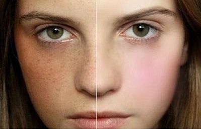 專業(yè)修復(fù)雙眼皮評(píng)論解析，醫(yī)生點(diǎn)評(píng)&網(wǎng)友手術(shù)對(duì)比曝光，必看照片分享