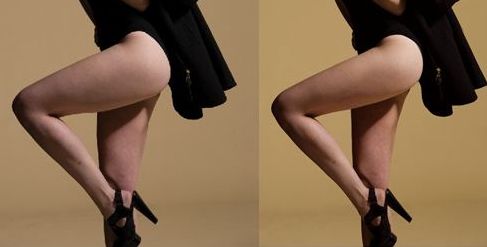 蘭州亞韓整形醫(yī)院的雙眼皮手術(shù)效果如何？親身體驗(yàn)分享+手術(shù)案例解析