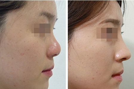 成都哪個醫(yī)生在鼻子整形領(lǐng)域當(dāng)之無愧！引領(lǐng)潮流的頂級專家盤點