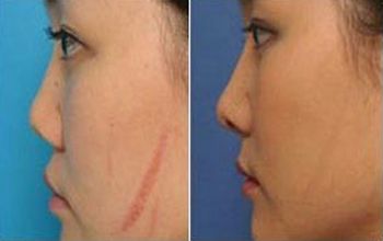 廣州眼部整形三甲醫(yī)院雙眼皮手術最新排行榜發(fā)布