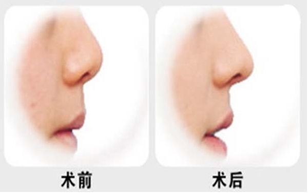 燕雄鼻子整容結(jié)果亮相！專家實(shí)力和成功案例揭秘