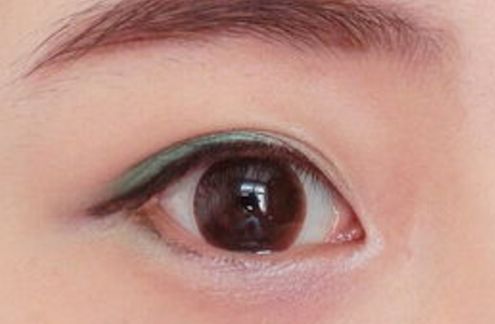 廣州高尚整形美容醫(yī)院隆鼻技術(shù)優(yōu)勢揭秘，80天細(xì)節(jié)圖曝光！