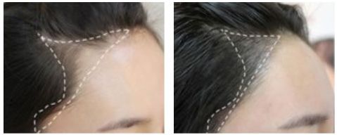 西安丁合軍的鼻子修復(fù)效果如何？90天真實案例分享