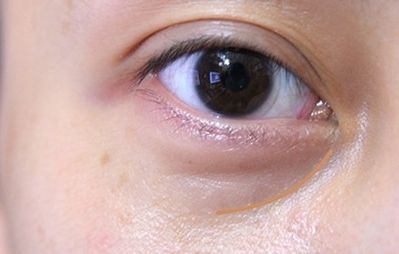 重慶美萊鄭楠醫(yī)生眼部整形術(shù)情況、資料及價(jià)格請(qǐng)參考