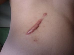 滄州靜港醫(yī)院雙眼皮手術(shù)效果如何？哪位醫(yī)生值得信賴？手術(shù)費(fèi)用參考表同步分享