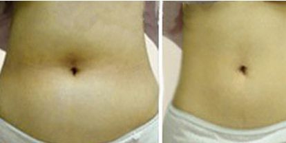 深圳李曉平醫(yī)生鼻部整形：實(shí)力醫(yī)生的案例展示