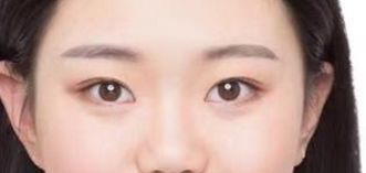 山東省立醫(yī)院整形外科激光祛斑真的有效嗎？