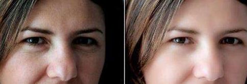 南京塑美顏吳應(yīng)凱丨鼻部重塑矯正持久效果曝光