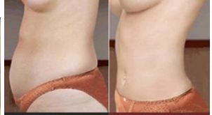 長沙哪家醫(yī)院做隆胸比較好？權(quán)威機構(gòu)助你塑造完美曲線！