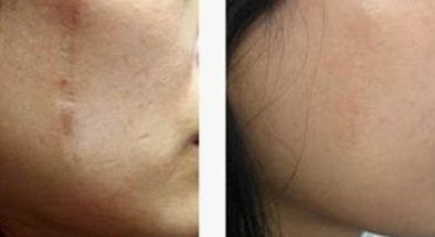 國內(nèi)有哪些值得推薦的磨骨權(quán)威專家？優(yōu)秀磨骨師張笑天、李志海等值得關(guān)注