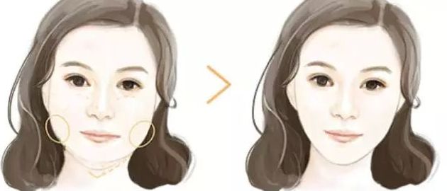 北京黎星醫(yī)生的面部脂肪填充效果如何？真實案例揭秘！