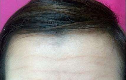 陳金超醫(yī)生高效雙眼皮效果秀！超卓案例展示揭示驚喜效果！