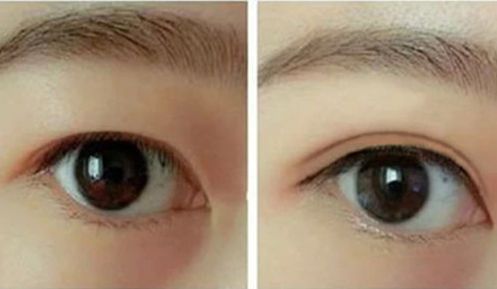 李世榮隆鼻的效果如何？西南醫(yī)院醫(yī)生經(jīng)典案例揭秘