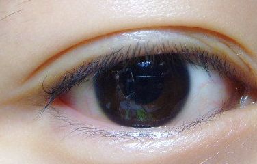 健麗整形醫(yī)院的去眼袋效果如何？2023患者分享案例！