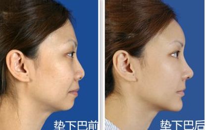 上海九院鼻部整形手術專家李圣利，專業(yè)水準如何？