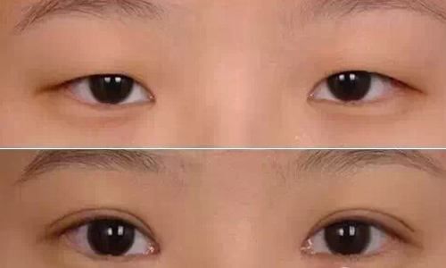 令人驚嘆！揭秘武漢華亞吳欣醫(yī)生的雙眼皮手術(shù)，身份資料披露！