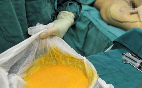 看準(zhǔn)這些?？漆t(yī)院，清楚雙眼皮手術(shù)，哪家最靠譜？