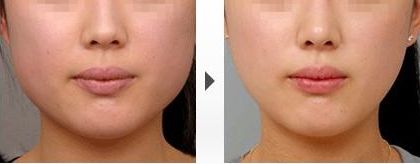 國內(nèi)治療兔唇的整形醫(yī)院排名大揭秘！這幾家醫(yī)院都在榜上