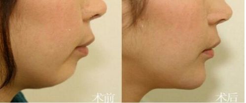 北京市前十名正頜醫(yī)院推薦：八處，協(xié)和，聯(lián)合麗格等，專業(yè)可靠！