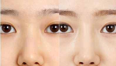 專業(yè)排行榜出爐！北京最頂級雙眼皮醫(yī)生名單公布！