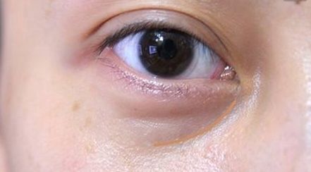 湘雅龍劍虹：雙眼皮案例解析及專業(yè)醫(yī)生簡(jiǎn)介