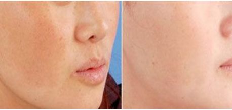 朱海男全切雙眼皮手術(shù)費(fèi)用及醫(yī)生簡(jiǎn)介、價(jià)格表解析！