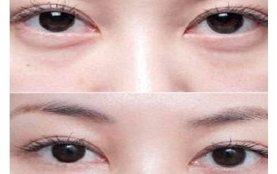 北京張笑天的下頜角手術(shù)技術(shù)及豐碩成果曝光！醫(yī)術(shù)精湛，案例展示震撼人心