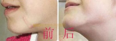 上海哪家醫(yī)院有專業(yè)的唇裂手術(shù)醫(yī)生？治療兔唇患者的必備信息！