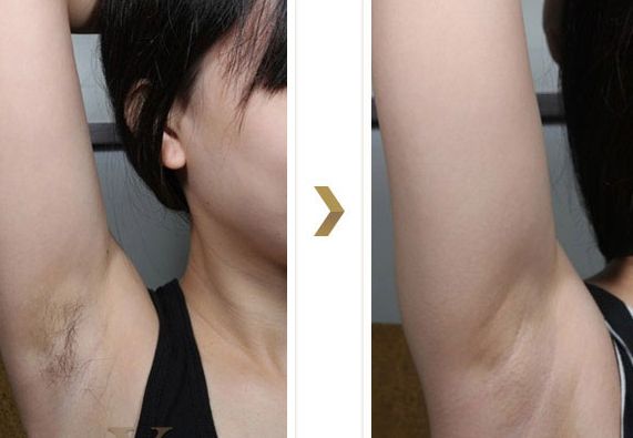 長(zhǎng)沙湘雅醫(yī)院的減肥科如何？大腿吸脂效果如何？