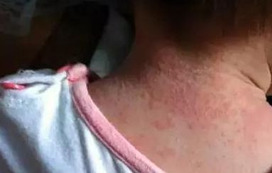 黃開亮眼睛美不美，醫(yī)生經(jīng)驗公開！看雙眼皮整形成功案例