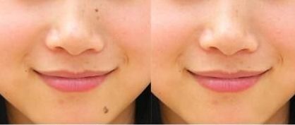 上海九院李茅醫(yī)生的雙眼皮手術(shù)效果如何？90天見證分享給你！