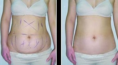 鄭州沐整形醫(yī)院：親測雙眼皮效果分享