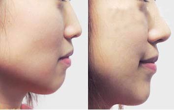 珠海采用新技術，瞬間消除黑眼圈的專業(yè)美容醫(yī)院預約