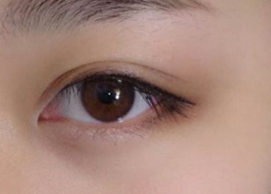 重慶2023年雙眼皮醫(yī)生：吳小樓、曹陽、何勝旗醫(yī)術(shù)對比