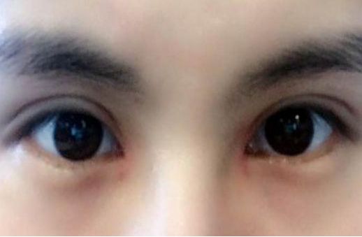 專家執(zhí)針絕活，您知道哪位醫(yī)生在注射物取出方面最厲害嗎？獨特手法排行榜前五名大揭曉