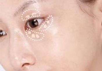 杭州葉秀娣做雙眼皮具體效果如何？專家實踐案例發(fā)布